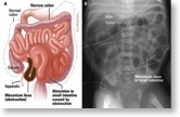 meconium_ileus2